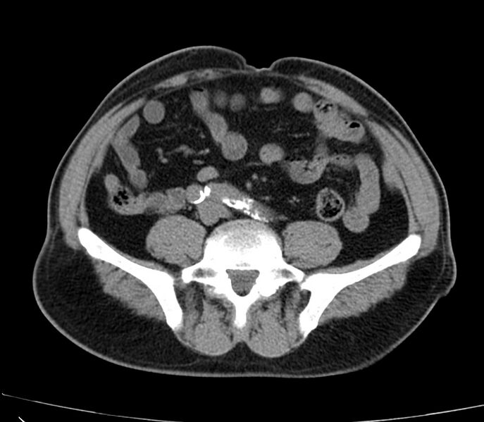 File:Abdominal aortic aneurysm (Radiopaedia 22421-22458 non-contrast 36).jpg