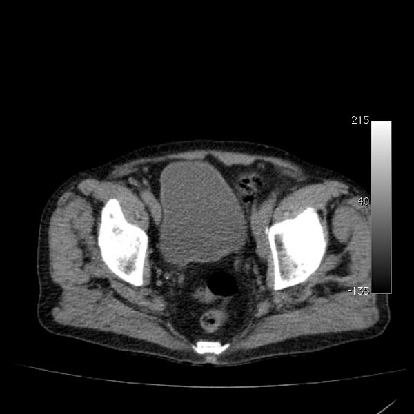 File:Abdominal aortic aneurysm (Radiopaedia 29248-29660 Axial non-contrast 51).jpg