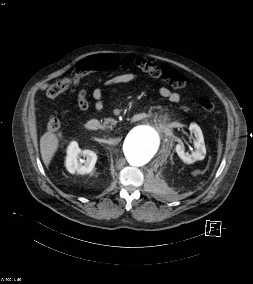 Abdominal aortic aneurysm with intramural hematoma then rupture (Radiopaedia 50278-55632 Axial C+ arterial phase 68).jpg
