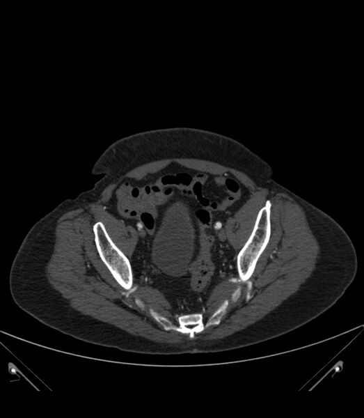File:Abdominal aortic aneurysm with thrombus fissuration (Radiopaedia 46218-50618 Axial C+ arterial phase 37).jpg