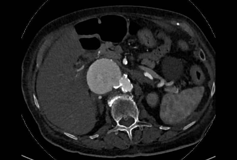 File:Abdominal aortic aneurysm with thrombus fissuration (Radiopaedia 73192-83919 Axial C+ arterial phase 42).jpg