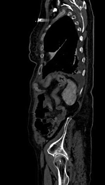 File:Abdominal aortic aneurysm with thrombus fissuration (Radiopaedia 73192-83919 Sagittal C+ arterial phase 16).jpg