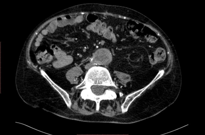 File:Abdominal aortic interposition tube graft and aneurysm thrombosis (Radiopaedia 71438-81857 Axial C+ arterial phase 124).jpg