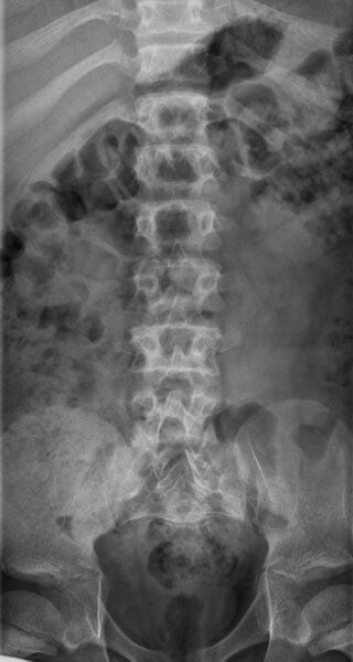 File:Achondroplasia (Radiopaedia 9294-9979 D 4).jpg