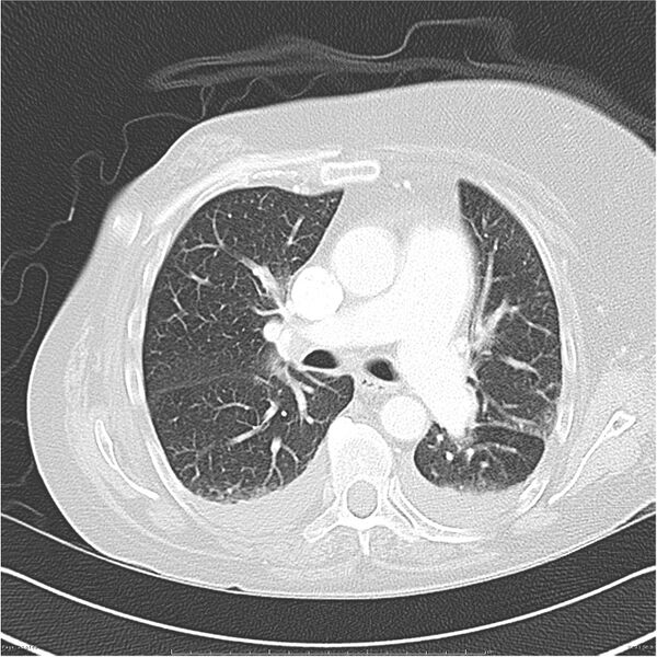 File:Acute-on-chronic pulmonary emboli (Radiopaedia 27925-28169 lung window 21).jpg