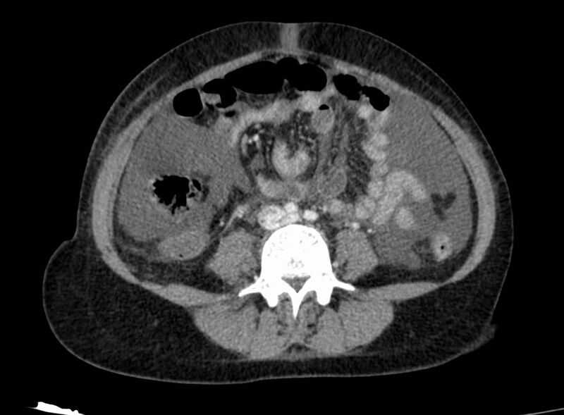 File:Acute Budd-Chiari syndrome (Radiopaedia 60858-68638 Axial C+ portal venous phase 185).jpg