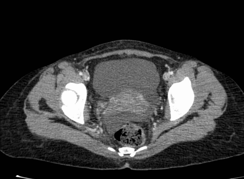 File:Acute Budd-Chiari syndrome (Radiopaedia 60858-68638 Axial C+ portal venous phase 272).jpg