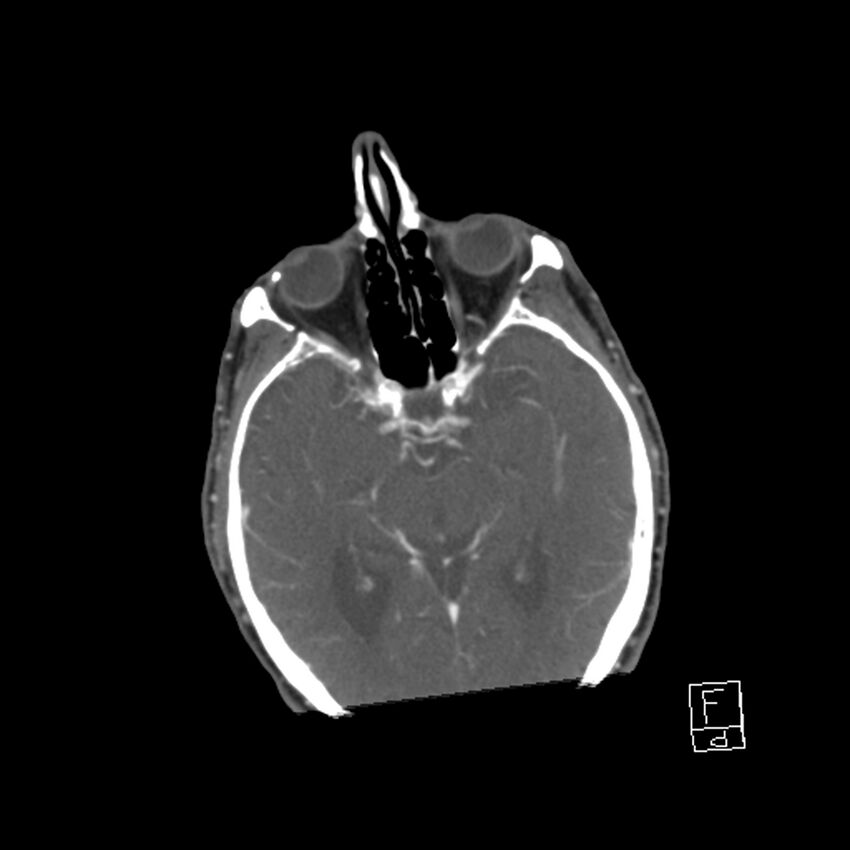 Acute ICA ischemic penumbra due to high-grade CCA stenosis (CT perfusion) (Radiopaedia 72038-82530 Axial C+ arterial phase 7).jpg
