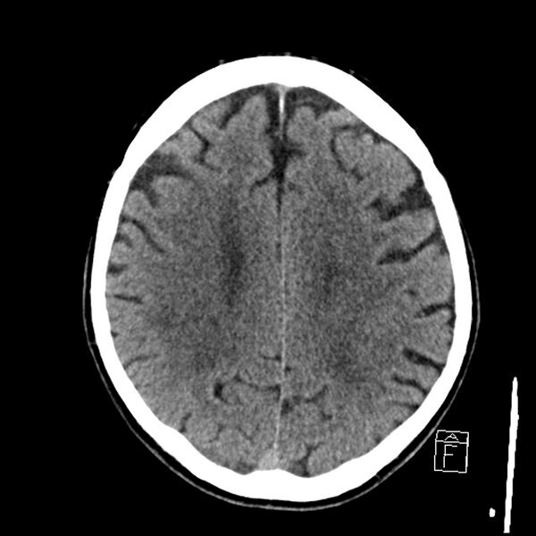 File:Acute P1 occlusion with PCA ischemia penumbra (CT perfusion) (Radiopaedia 72084-82586 Axial non-contrast 30).jpg