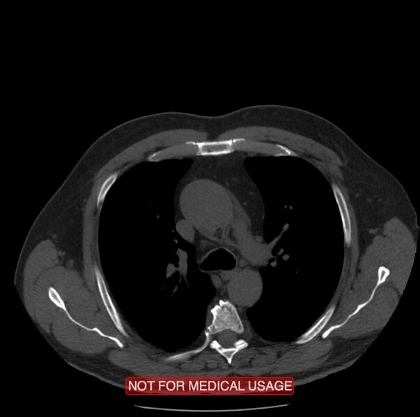 File:Acute aortic dissection - Stanford type A (Radiopaedia 40661-43285 Axial non-contrast 14).jpg