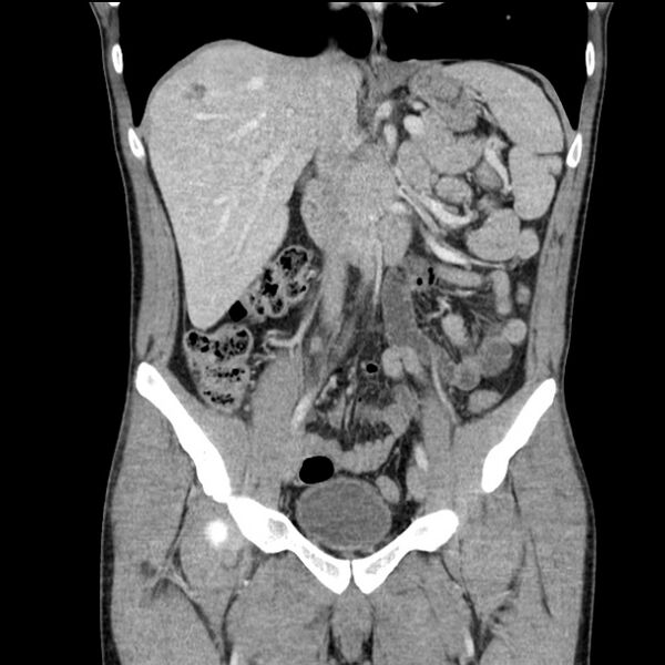 File:Acute appendicitis (Radiopaedia 27049-27227 Coronal C+ portal venous phase 25).jpg