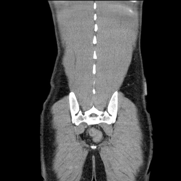 File:Acute appendicitis (Radiopaedia 27049-27227 Coronal C+ portal venous phase 53).jpg