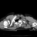 Acute aspiration pneumonitis (Radiopaedia 33605-34703 Axial non-contrast 18).jpg