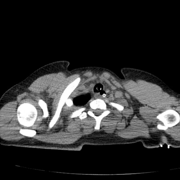 File:Acute aspiration pneumonitis (Radiopaedia 33605-34703 Axial non-contrast 18).jpg