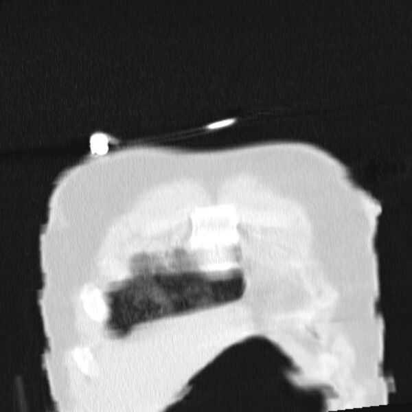 File:Acute aspiration pneumonitis (Radiopaedia 33605-34703 Coronal lung window 11).jpg