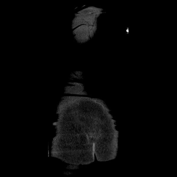 File:Acute cholecystitis and incidental left sided IVC (Radiopaedia 49352-54459 Coronal C+ portal venous phase 4).jpg