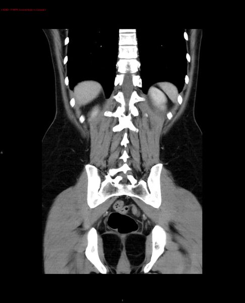 File:Acute gastritis (Radiopaedia 21043-20975 Coronal C+ portal venous phase 1).jpg