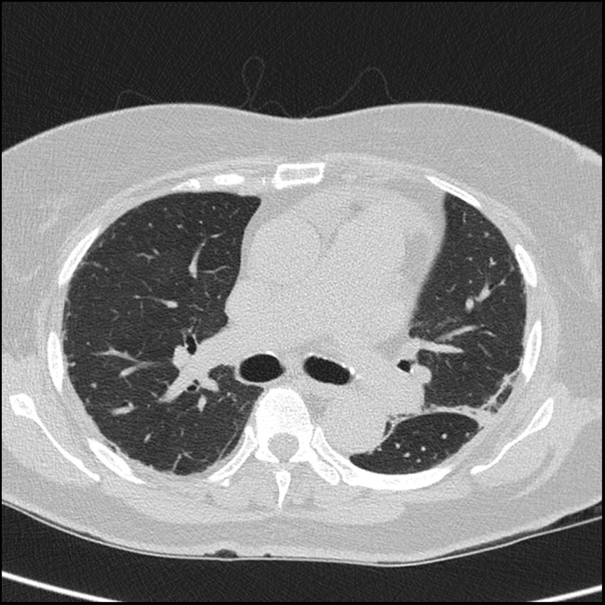 Acute interstitial pneumonitis (Radiopaedia 45404-49453 Axial lung window 37).jpg
