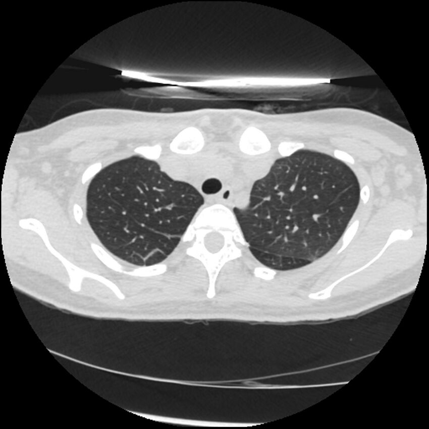 Acute lupus nephritis (Radiopaedia 45832-50107 Axial lung window 16).jpg