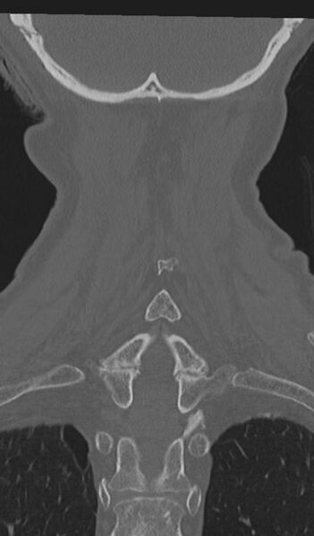 File:Acute on chronic subdural hematoma and thoracic vertebral injury in a multitrauma patient (Radiopaedia 31698-32619 Coronal bone window 53).jpg