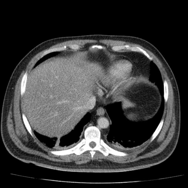 File:Acute pancreatitis (Radiopaedia 26663-26813 Axial C+ portal venous phase 11).jpg