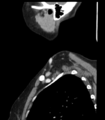 Acute parotitis (Radiopaedia 27425-27619 Sagittal C+ portal venous phase 50).png