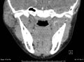 Acute parotitis (Radiopaedia 54123-60294 Coronal C+ arterial phase 3).jpg
