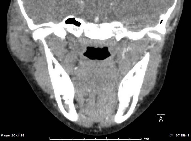 File:Acute parotitis (Radiopaedia 54123-60294 Coronal C+ arterial phase 3).jpg