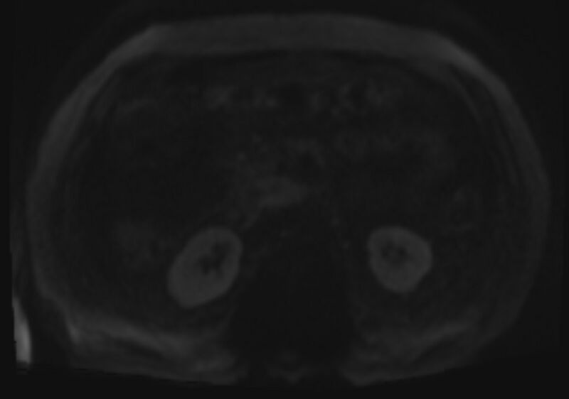 File:Acute portal vein thrombosis (Radiopaedia 73198-83925 Axial DWI 82).jpg