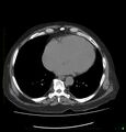 Acute renal failure post IV contrast injection- CT findings (Radiopaedia 47815-52557 Axial non-contrast 4).jpg