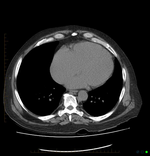 File:Acute renal failure post IV contrast injection- CT findings (Radiopaedia 47815-52557 Axial non-contrast 4).jpg