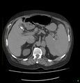 Acute renal failure post IV contrast injection- CT findings (Radiopaedia 47815-52559 Axial C+ portal venous phase 25).jpg