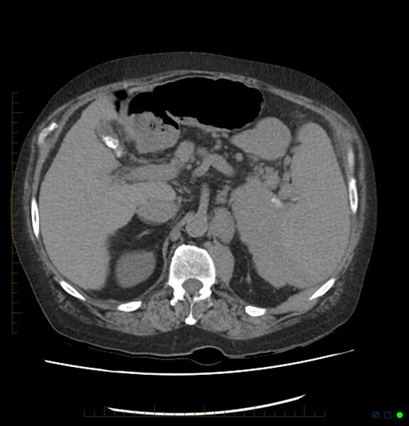 File:Acute renal failure post IV contrast injection- CT findings (Radiopaedia 47815-52559 Axial C+ portal venous phase 25).jpg