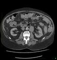 Acute renal failure post IV contrast injection- CT findings (Radiopaedia 47815-52559 Axial C+ portal venous phase 37).jpg