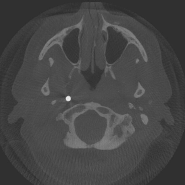File:Acute subarachnoid hemorrhage and accessory anterior cerebral artery (Radiopaedia 69231-79010 Axial arterial - MIP 3).jpg
