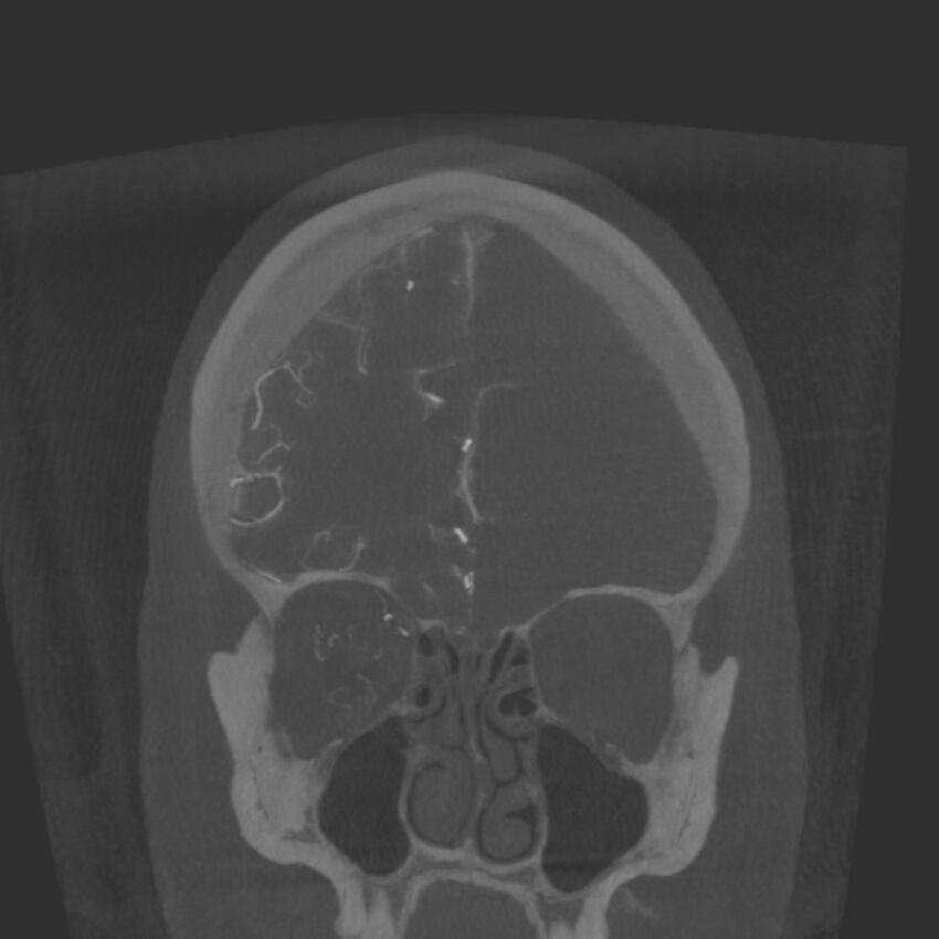 Acute subarachnoid hemorrhage and accessory anterior cerebral artery (Radiopaedia 69231-79010 Coronal arterial - MIP 22).jpg