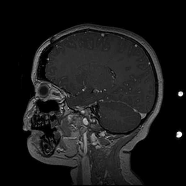 File:Adamantinomatous craniopharyngioma (Radiopaedia 77407-89529 H 45).jpg