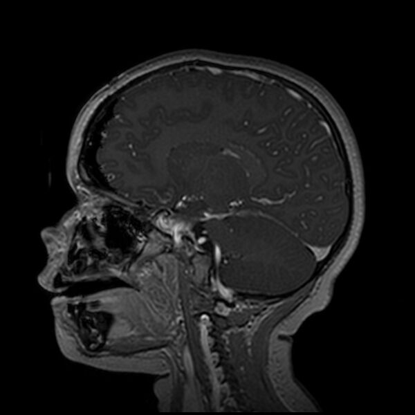 File:Adamantinomatous craniopharyngioma (Radiopaedia 77407-89529 H 51).jpg