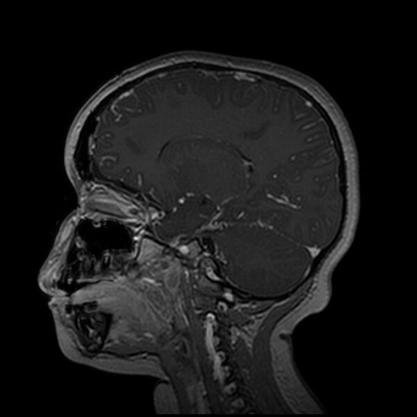 File:Adamantinomatous craniopharyngioma (Radiopaedia 77407-89529 H 75).jpg