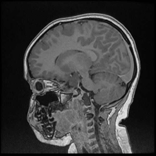 File:Adamantinomatous craniopharyngioma (Radiopaedia 77407-89529 Sagittal T1 C+ 79).jpg