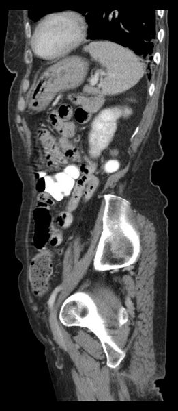 File:Adenocarcinoma of cecum (Radiopaedia 59222-66549 Sagittal C+ portal venous phase 18).jpg