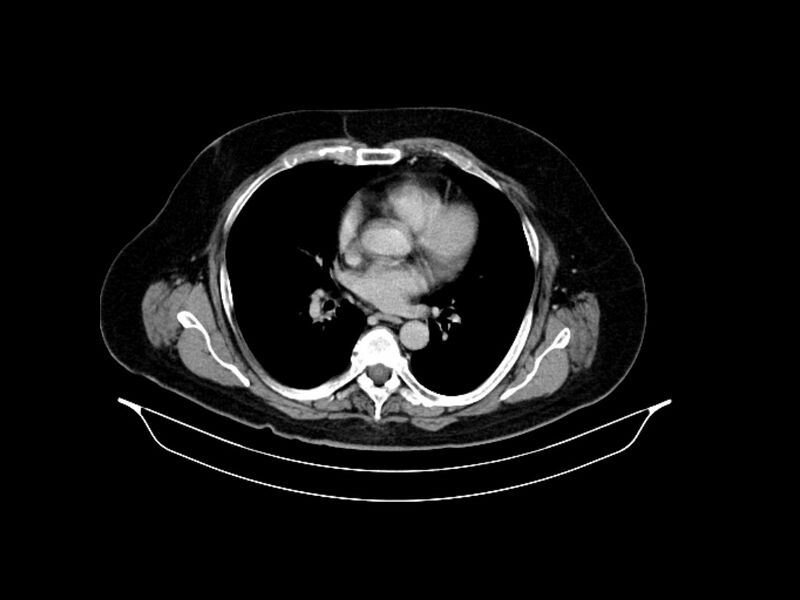 File:Adenocarcinoma of pancreas with hepatic metastasis (Radiopaedia 64332-73122 Axial C+ delayed 5).jpg