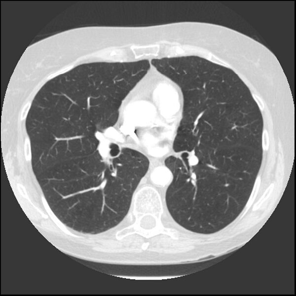 File:Adenocarcinoma of the lung (Radiopaedia 41015-43755 Axial lung window 62).jpg
