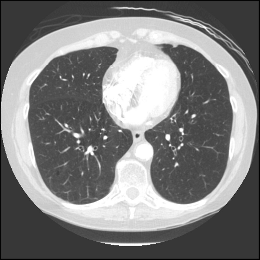 Adenocarcinoma of the lung (Radiopaedia 41015-43755 Axial lung window 82).jpg