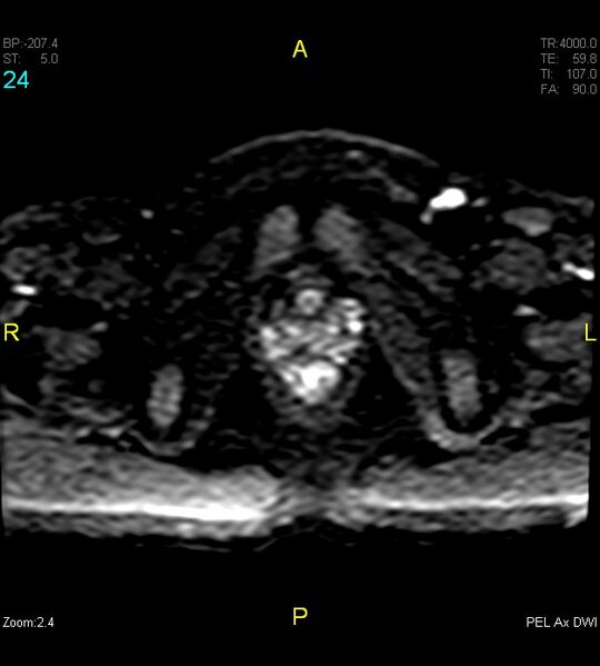 File:Adenomyosis (Radiopaedia 43504-46889 Axial DWI 24).jpg