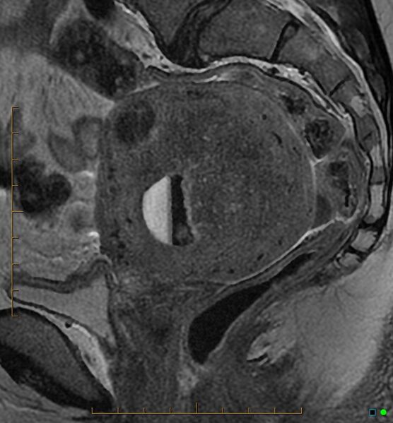 File:Adenomyosis uterus with hematometra (Radiopaedia 45779-50011 Sagittal T2 14).jpg