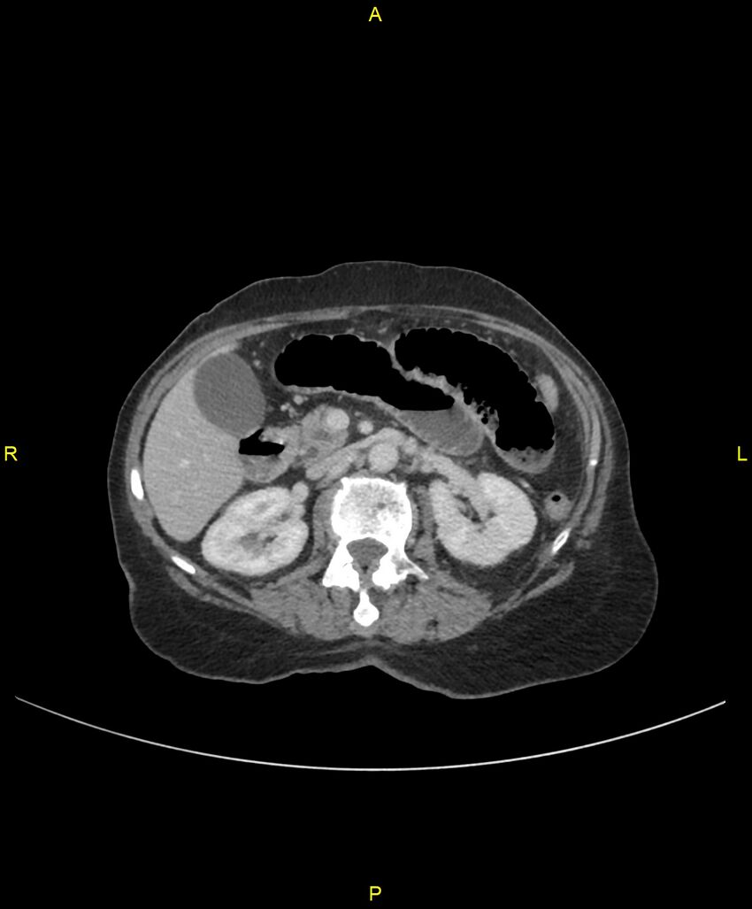 Adhesional small bowel obstruction (Radiopaedia 85402-101024 Axial C+ portal venous phase 107).jpg