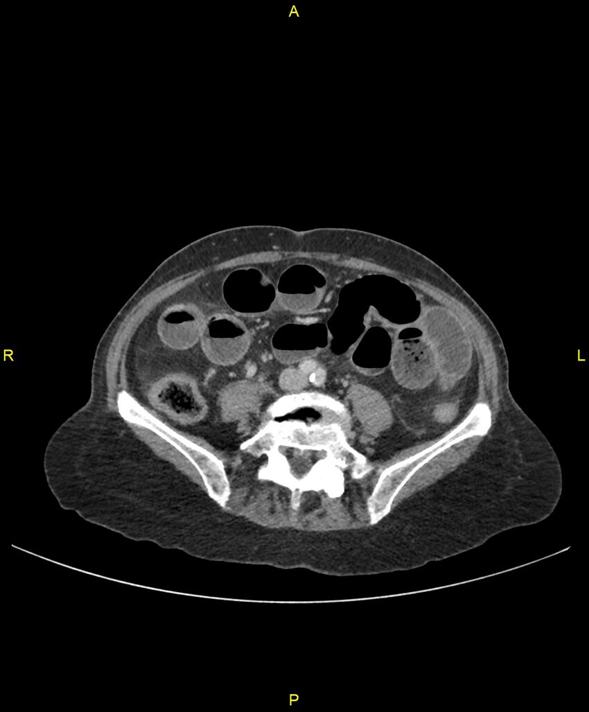 Adhesional small bowel obstruction (Radiopaedia 85402-101024 Axial C+ portal venous phase 178).jpg