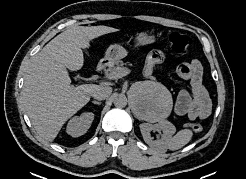 File:Adrenal metastases (Radiopaedia 73082-83791 Axial non-contrast 55).jpg