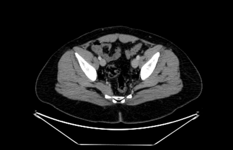 File:Adrenocortical carcinoma (Radiopaedia 80134-93438 Axial C+ portal venous phase 114).jpg